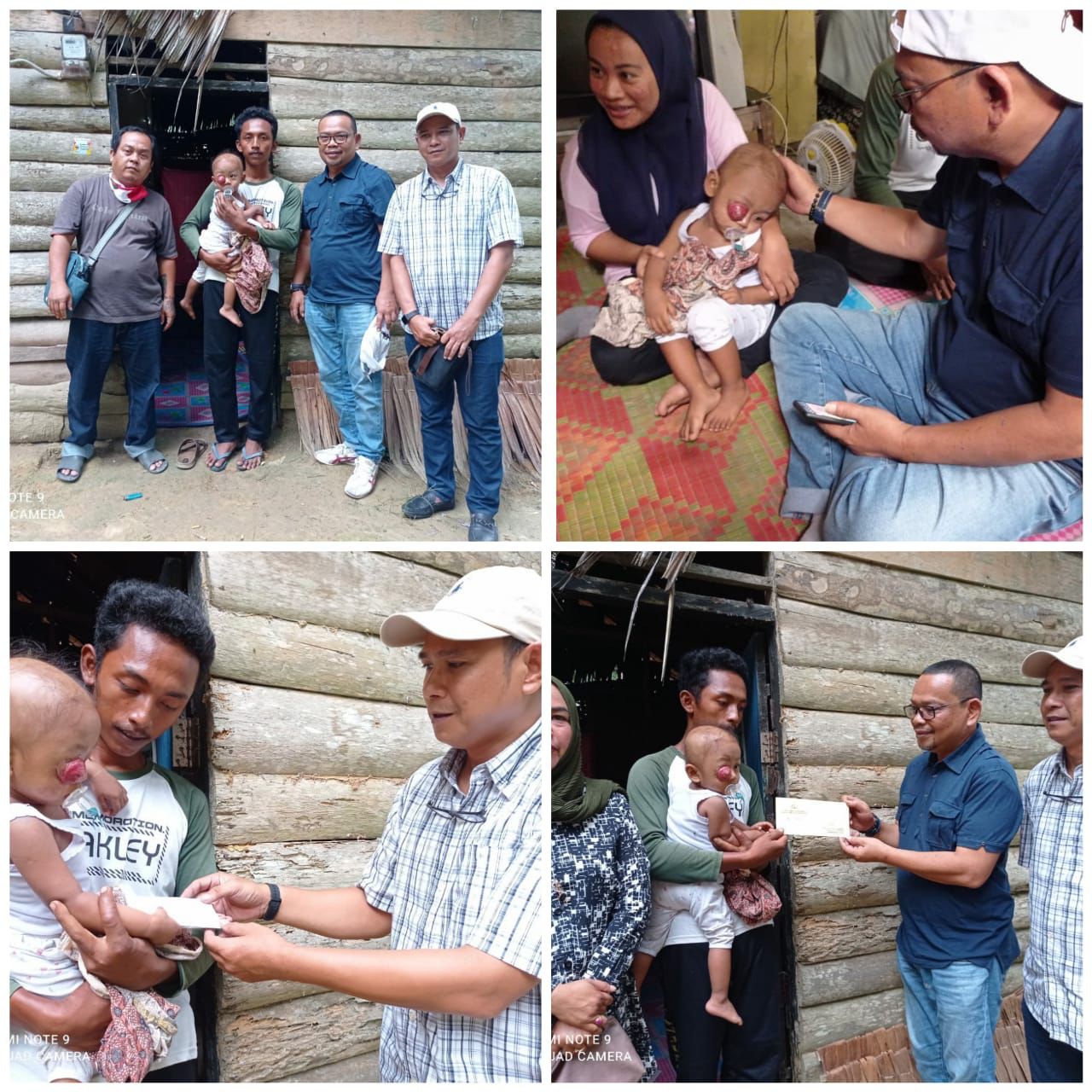 Aulia Andri dan Zakaria Rambe Salurkan Bantuan pada Bocah Penderita Tumor Mata