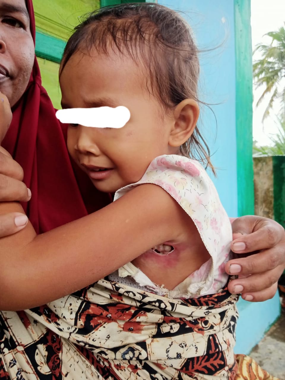 Ketiak Berlobang dan Bernanah, Balita ini Butuh Pertolongan Medis