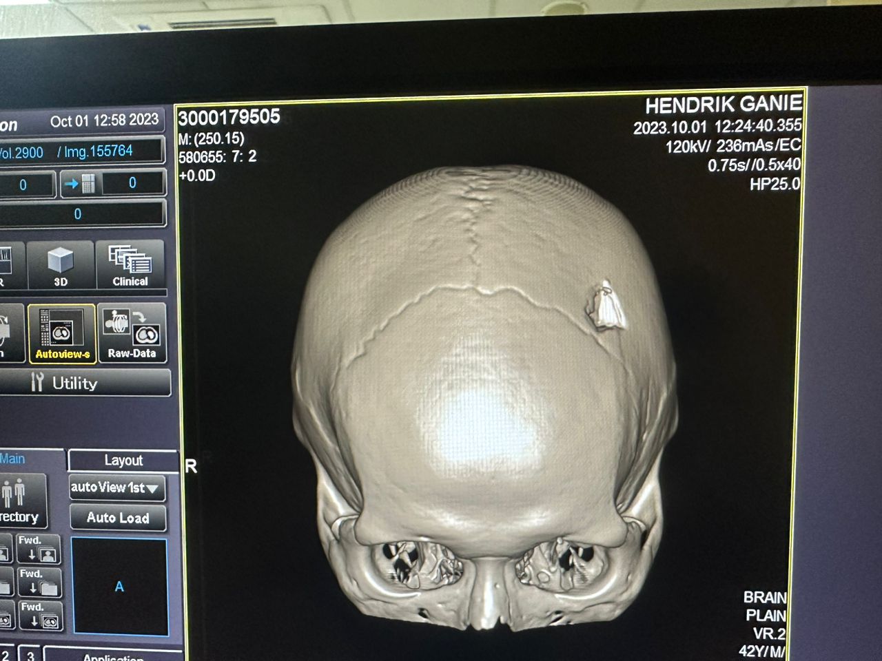 Pengunjung Hotel Grand Centra Hendrik Ganie Kepala Rentak Korban Pengeroyokan,   Kuasa Hukum Rinaldi SH : Ngadu ke Poltabes Minta Kasusnya Diproses Hukum
