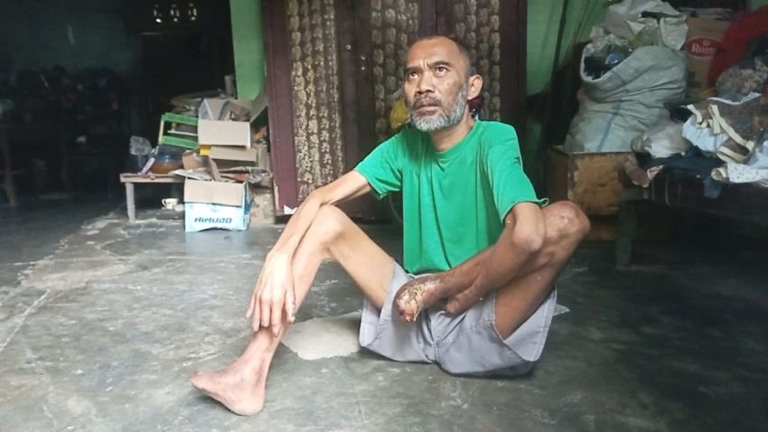 Sugianto Butuh Bantuan Pemerintah, Seluruh Jari Kaki Terlepas dari Badan, Seniman dan Pelukis Kaligrafi di Pantai Labu